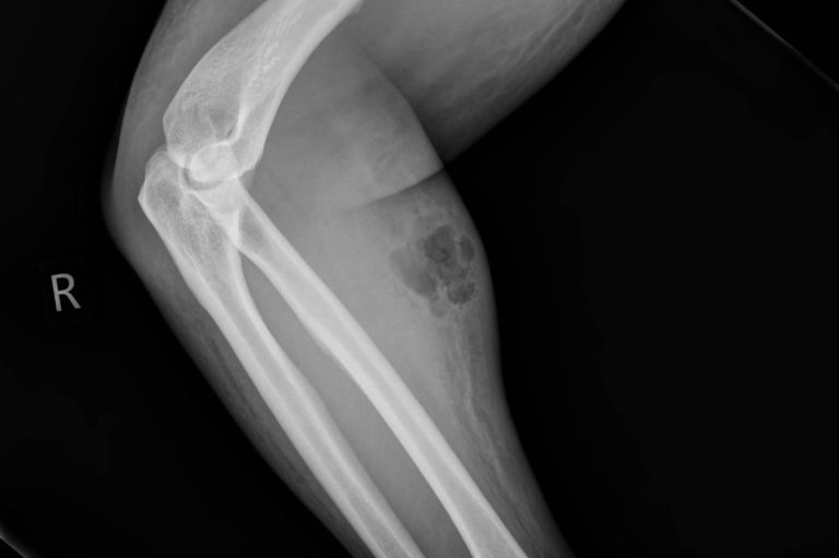 An x-ray of an arm, from the shoulder down, showing no damage to the bone but a smudge in the forearm region.