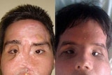 LtoR Face transplant recipient 'Oscar' before and after undergoing a face transplant