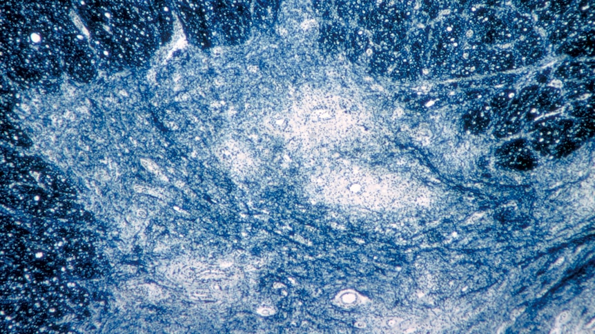 a microscope image showing damage to human spinal cord tissue from the polio virus