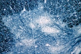 a microscope image showing damage to human spinal cord tissue from the polio virus