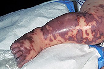 Meningococcal disease