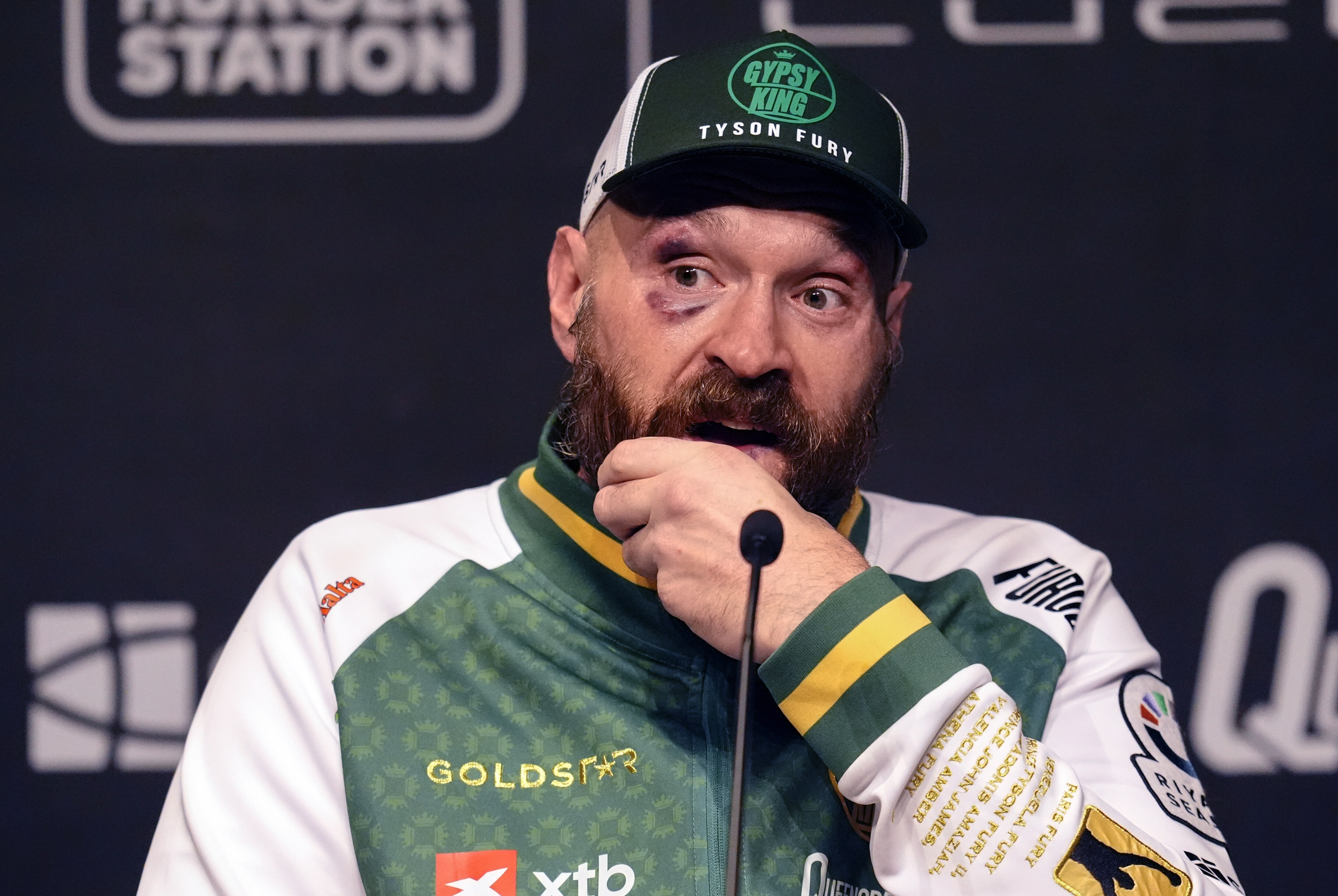 Tyson Fury se tient le menton avec un œil au beurre noir