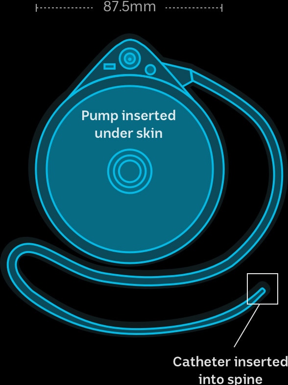Medtronic pump diagram