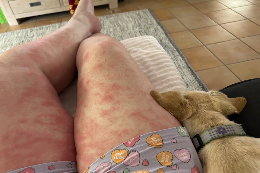 A woman with severe eczema on her legs sits on the couch with a dog beside her.