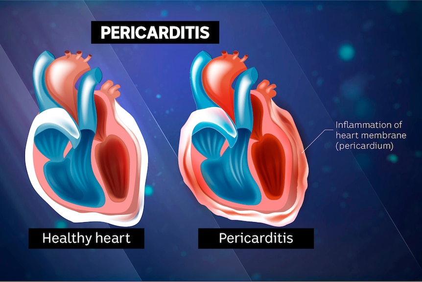 A graphic of a healthy heart next to one with pericarditis, which is surrounded by a slightly red, inflamed sac-like membrane.