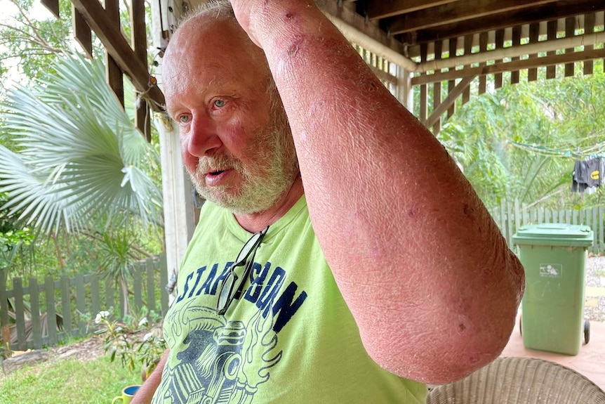 Man shows injuries on his arm.