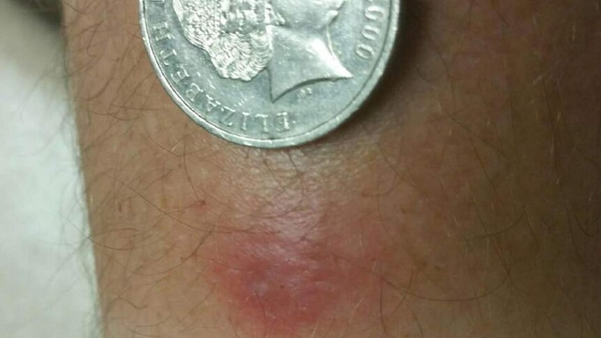 The Buruli ulcer starts like a small pimple on the skin.