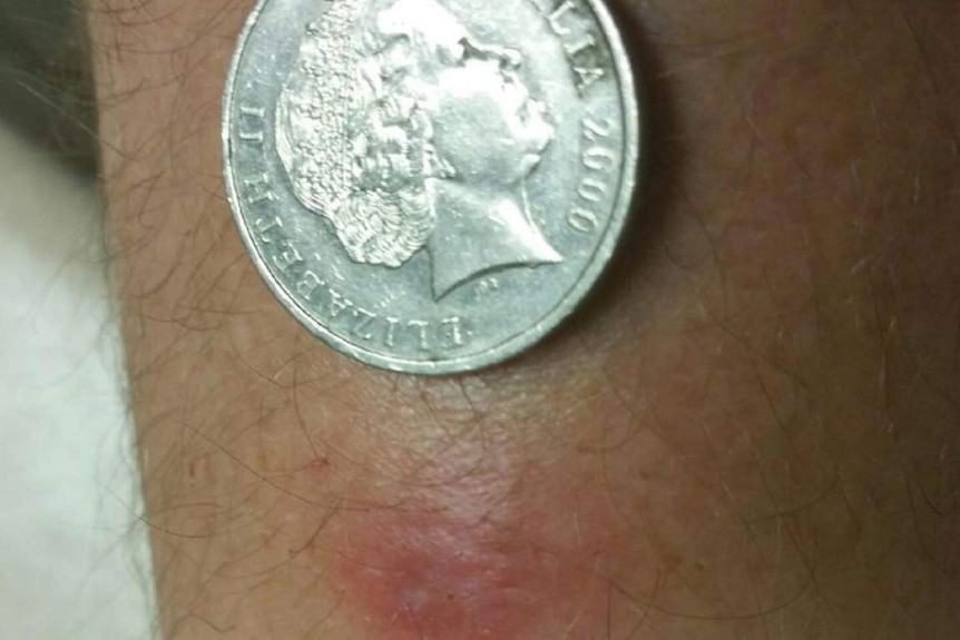 The Buruli ulcer starts like a small pimple on the skin.