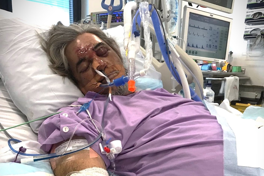 A man with facial injuries has tubes in his face and surrounded by hospital monitors while he lays asleep in bed.