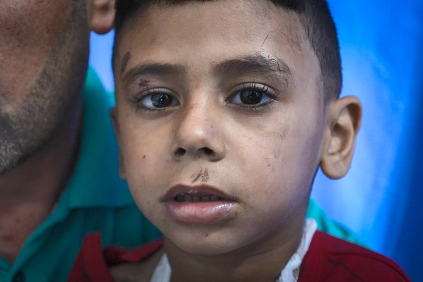 A little boy with scratches on his face