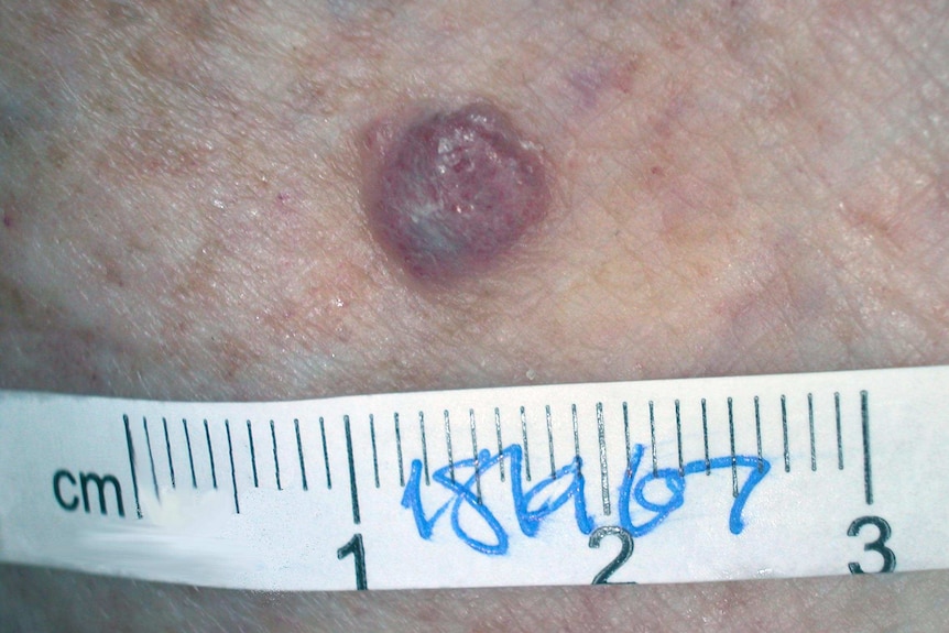 A close up image of a nodular melanoma on a patient.