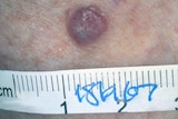 Eleven thousand Australians are diagnosed with melanoma each year.