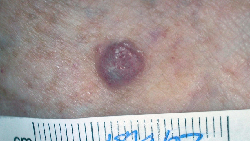 Australia has the highest incidence of melanoma in the world.