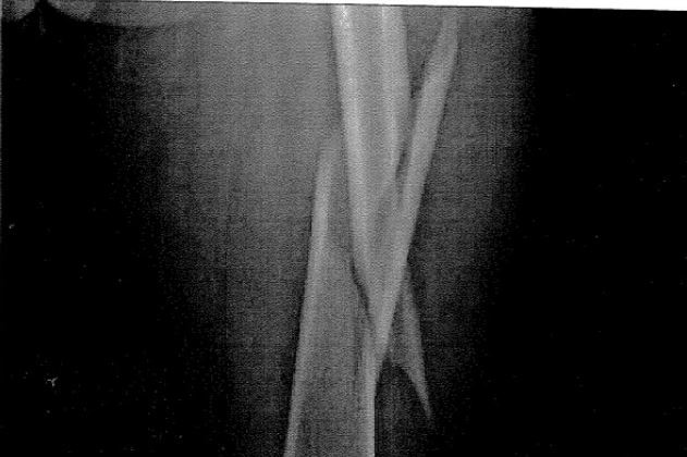 An xray reveals a sharp break in a bone.
