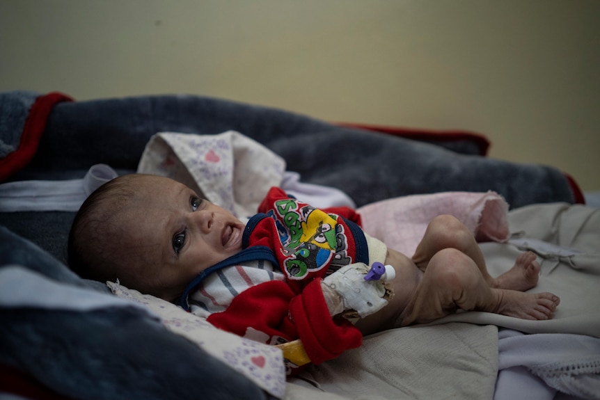 An undernourished and thin baby cries in red and white jumpsuit on hospital bed