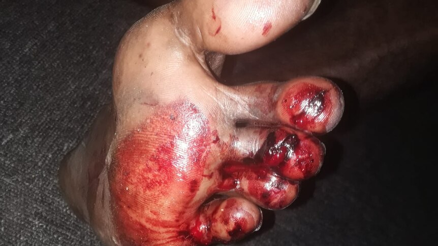 A foot covered in blood.