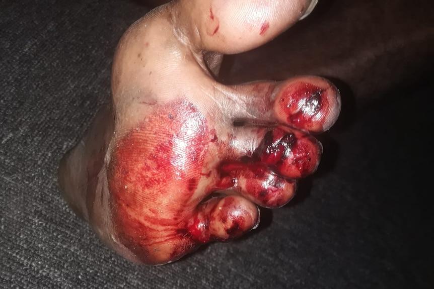 A foot covered in blood.