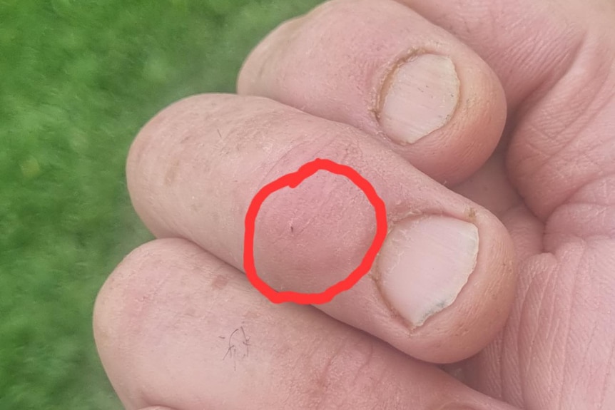 Tiny puncture wound on finger