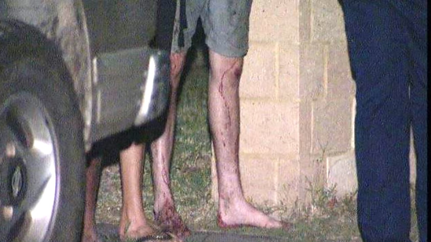 Close up of a man's bloodied legs.