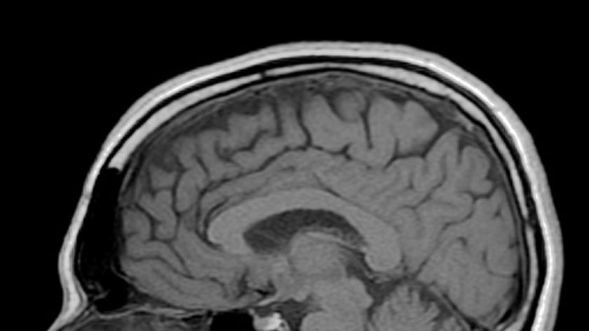 An MRI scan of a man's brain