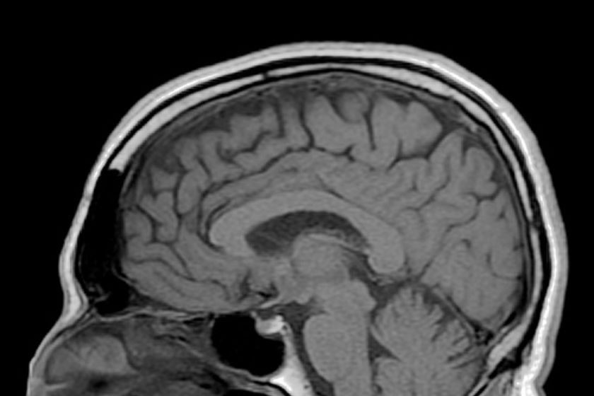 An MRI scan of a man's brain