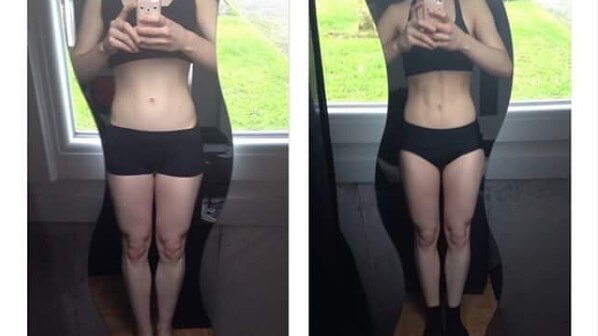 Two photos of same girl, before and after weight loss.