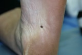 A melanoma on the bottom of the sole of patients foot.
