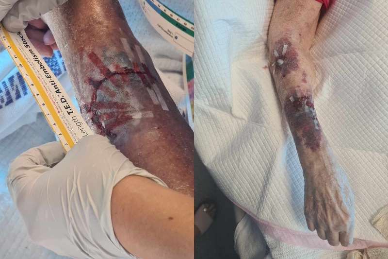 A picture of a skin tear on an elderly woman's shin. Another picture of tape on serious bruising to an the same woman's arm. 