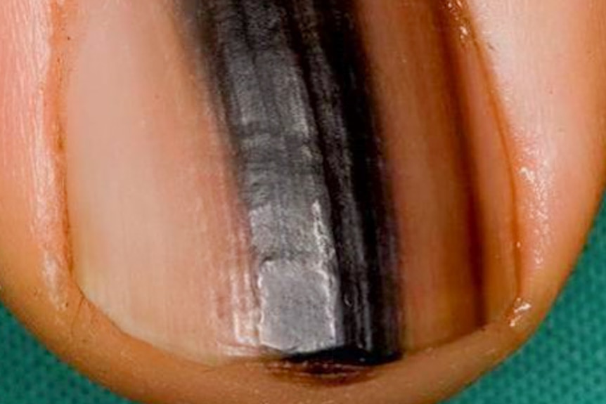 Close-up of a melanoma under a toe nail.