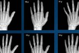 X-rays of hands and wrists from the Greulich and Pyle Altas, used to determine the age of children