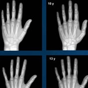 X-rays of hands and wrists from the Greulich and Pyle Altas, used to determine the age of children