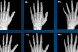 X-rays of hands and wrists from the Greulich and Pyle Altas, used to determine the age of children