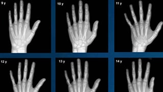 X-rays of hands and wrists from the Greulich and Pyle Altas, used to determine the age of children