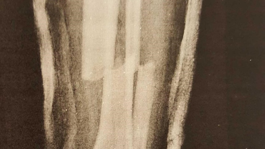 An X-ray image showing broken leg bones