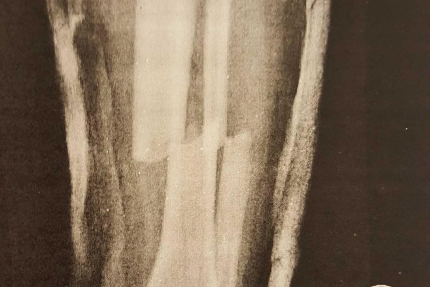An X-ray image showing broken leg bones