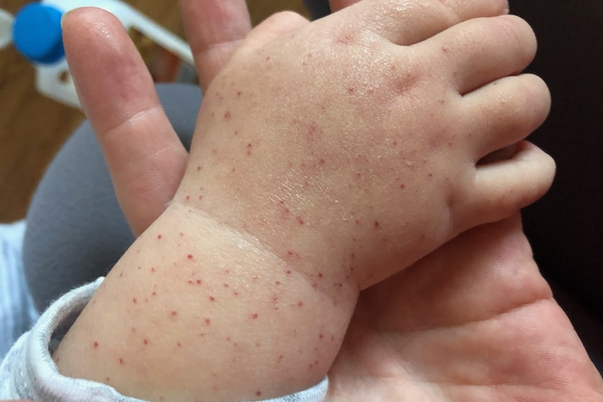 Close up photo of a rash on a child's hand and forearm.