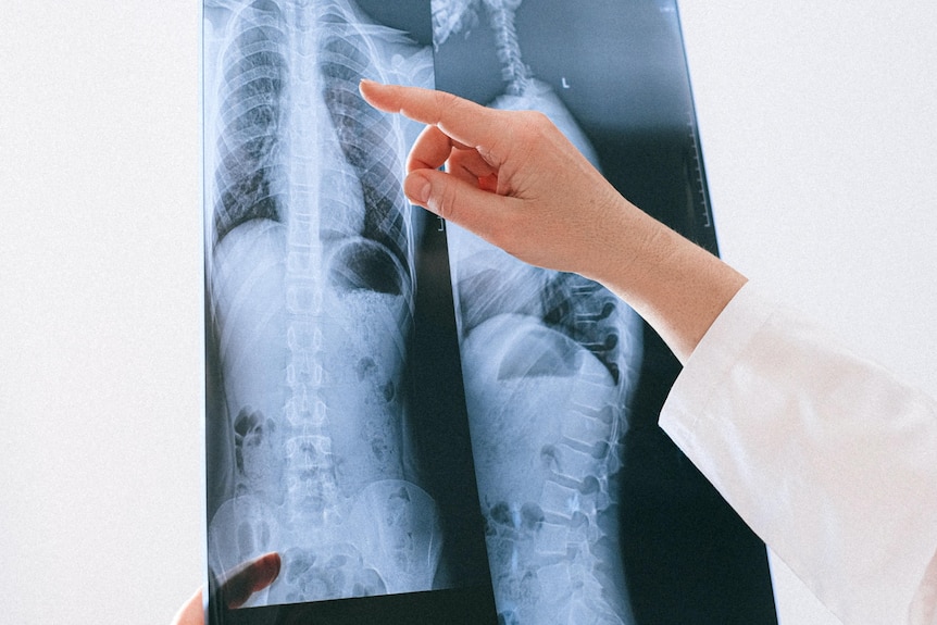 A woman holds up and points at a lung x-ray.
