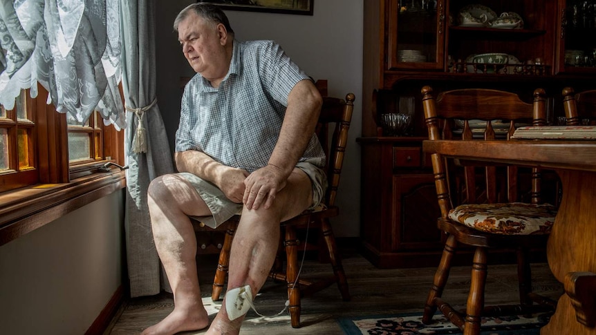 Brian Robert's poses for a photograph at home after suffering Compartment Syndrome from a motor bike accident .