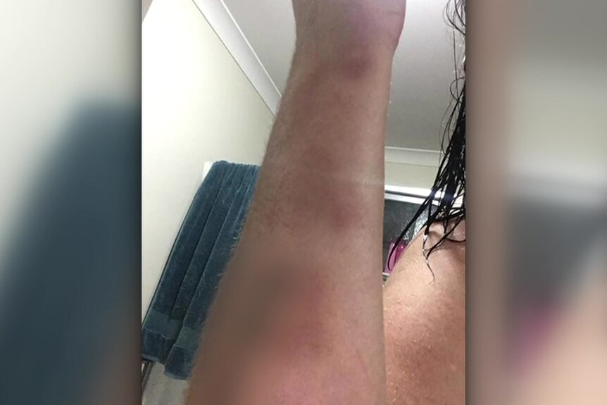 A woman's arm with extensive bruising. 
