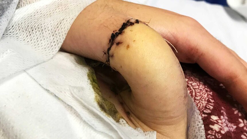 Britney Thomas had her thumb stitched to her groin.