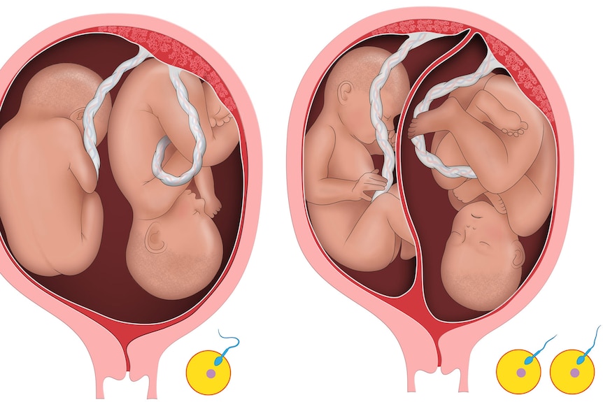 Two anatomical diagrams of twin babies in the womb. The first pair are in one sac, the second pair each have their own sac.
