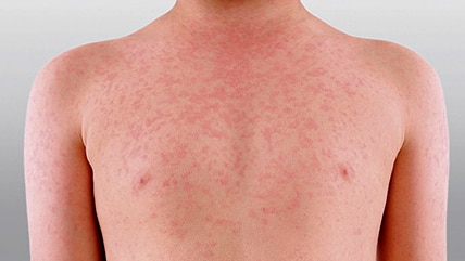 The torso and arms of a boy infected with measles showing a rash on his skin.