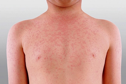 The torso and arms of a boy infected with measles showing a rash on his skin.