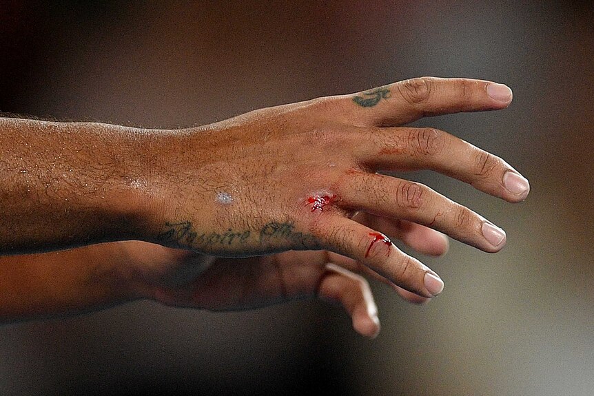 A picture of a player's hand with blood coming from two points.