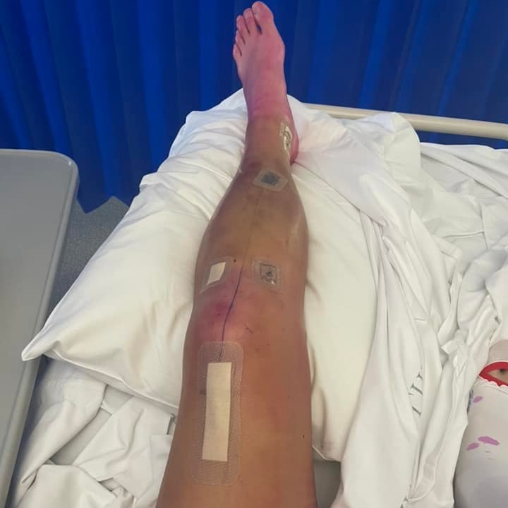 A leg post operation in hospital 