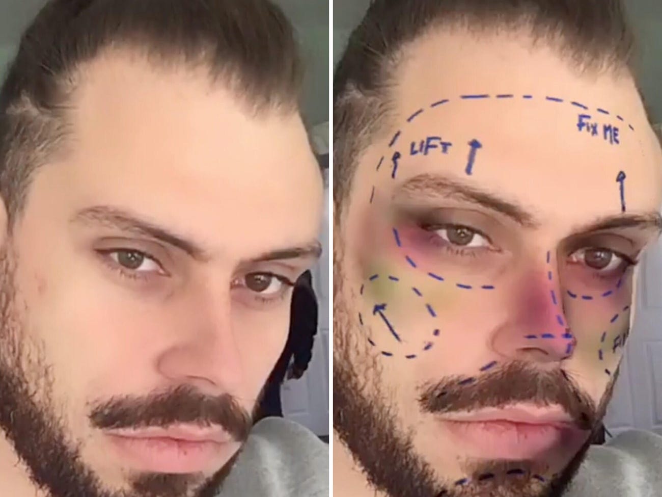 'Snapchat dysmorphia' Selfie filters may be driving young people to