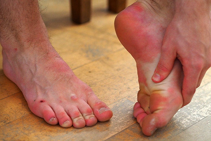 A close up photo of a pair of feet with marks and callouses from dancing.