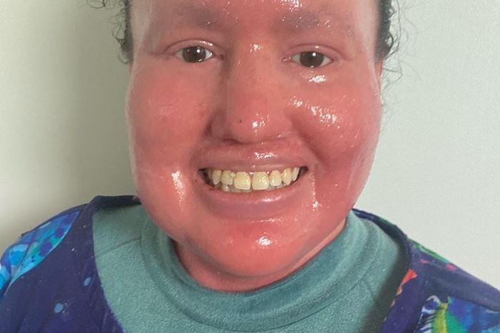 Close up of woman with red, shiny skin. She is smiling