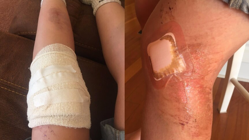 Photos of dressed injuries - scrapes and bruises - on Olivia Jones' legs. Olivia was caught in a crowd stampede.