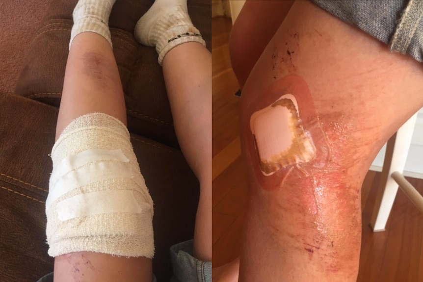 Photos of dressed injuries - scrapes and bruises - on Olivia Jones' legs. Olivia was caught in a crowd stampede.